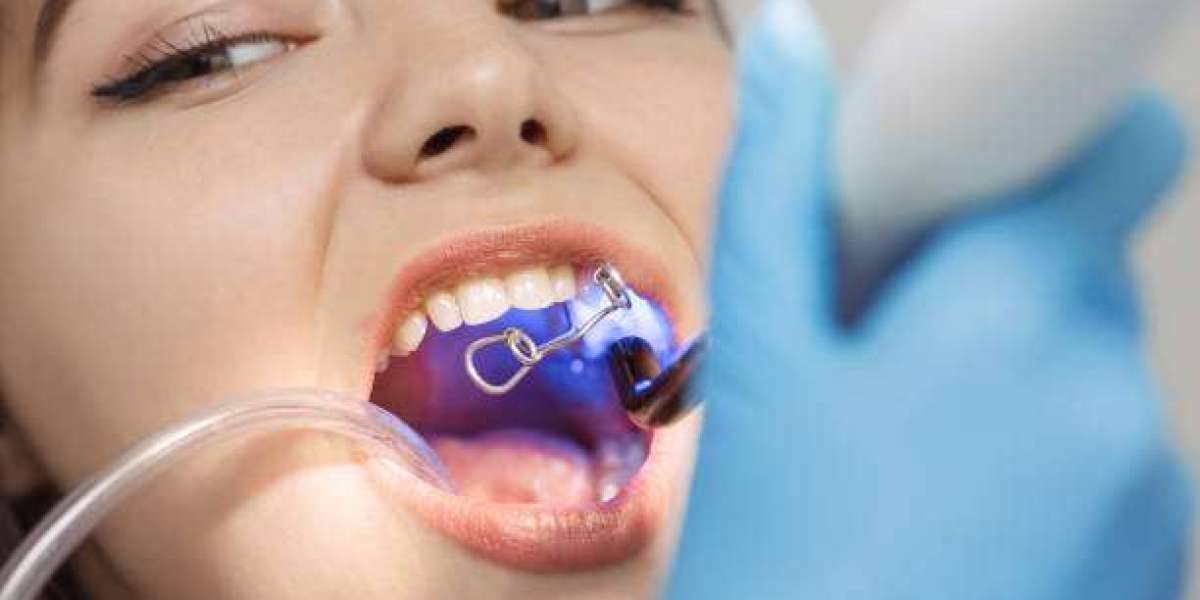 Dental Bonding in Mumbai By Opal Dental