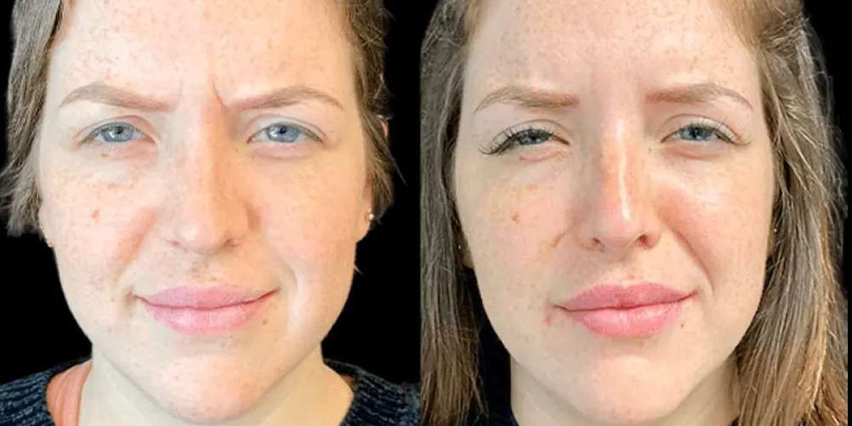 Finding the Right Clinic for Botox in Dubai