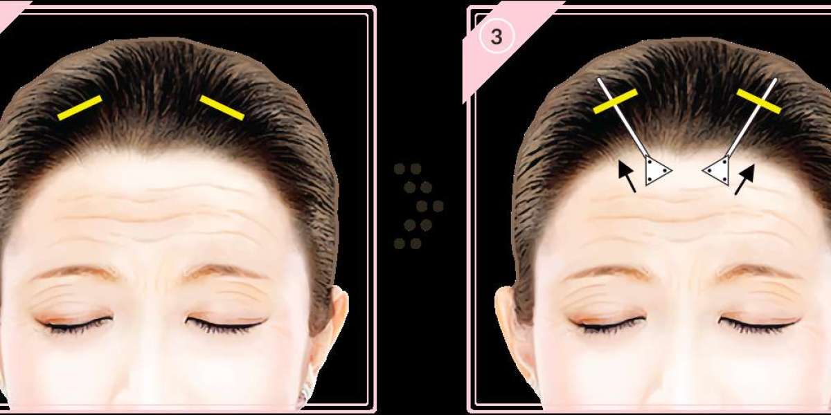 The Impact of a Refreshed Brow Line on Your Overall Facial Harmony