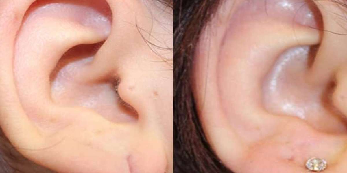 Earlobe Correction for Long-Term Ear Health