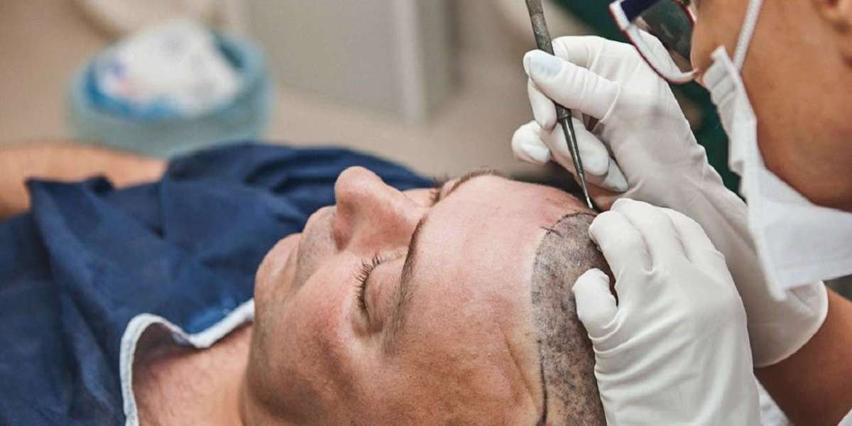 زراعة اللحية والشعر في الرياض: حلول متكاملة