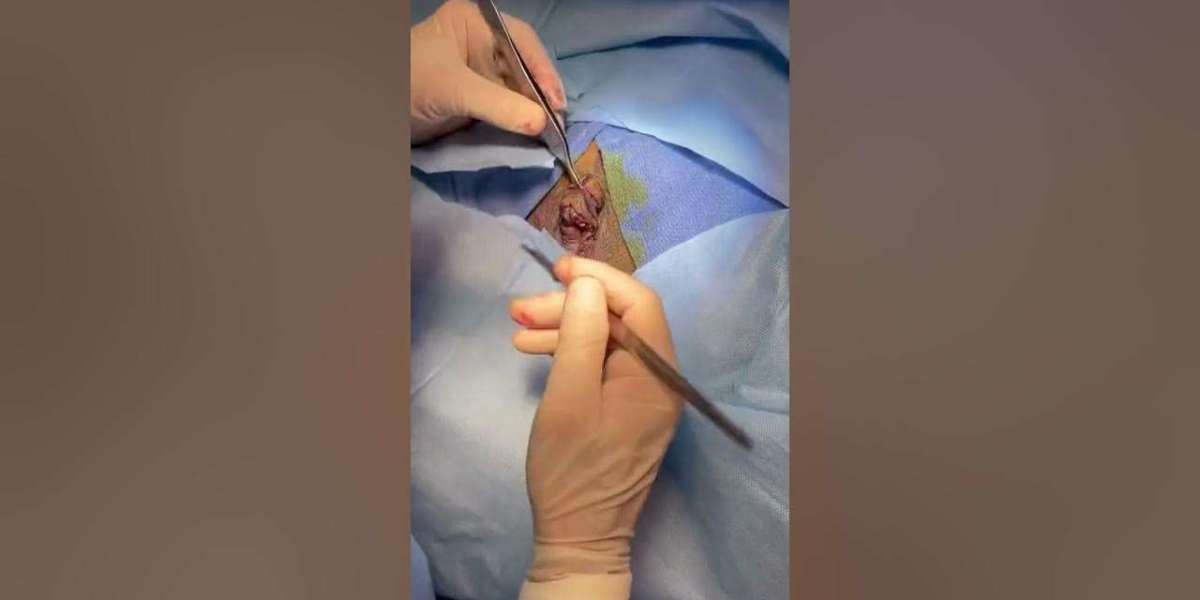 Premium Labiaplasty Surgery Riyadh