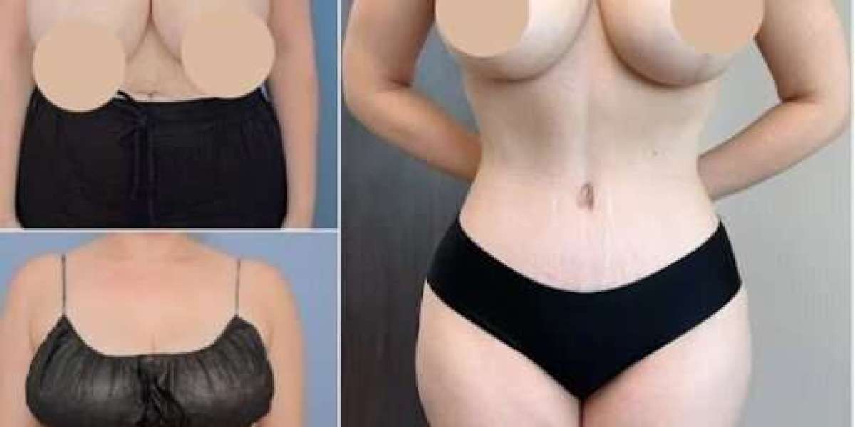 Transform Your Appearance with Tummy Tuck in Dubai