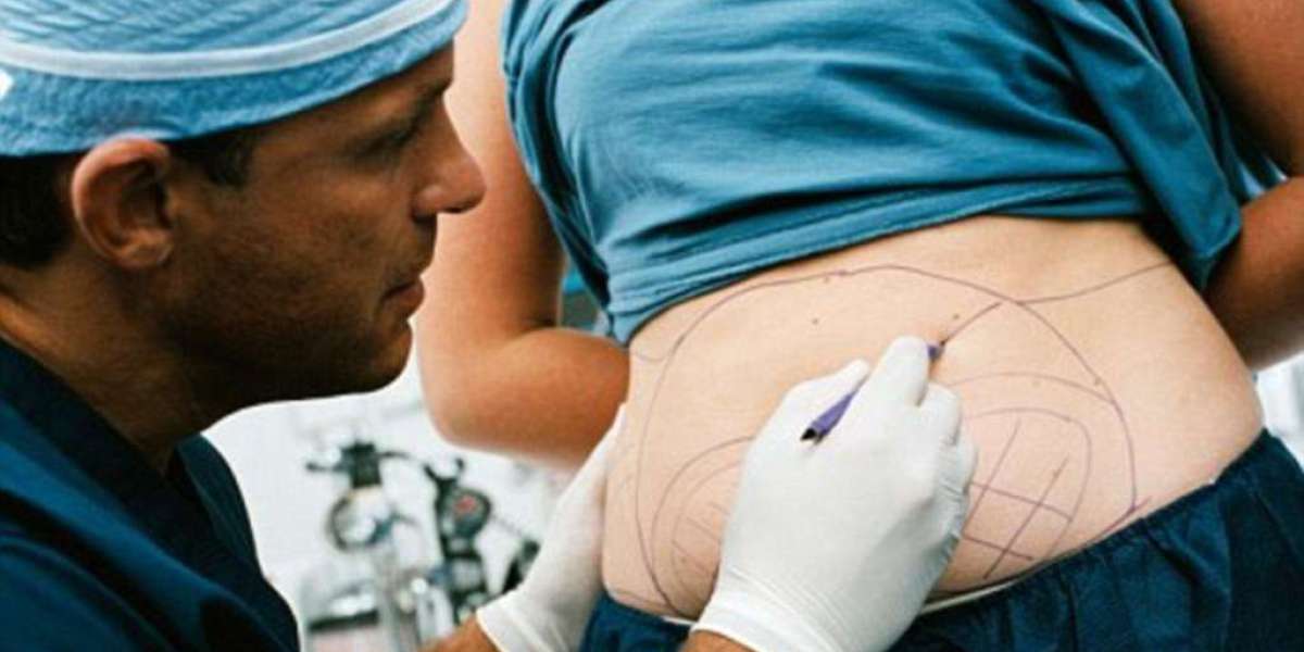 Advanced Body Contouring with Liposuction in Riyadh