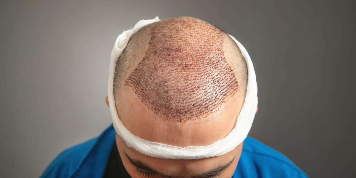 زراعة الشعر الآمنة في الرياض