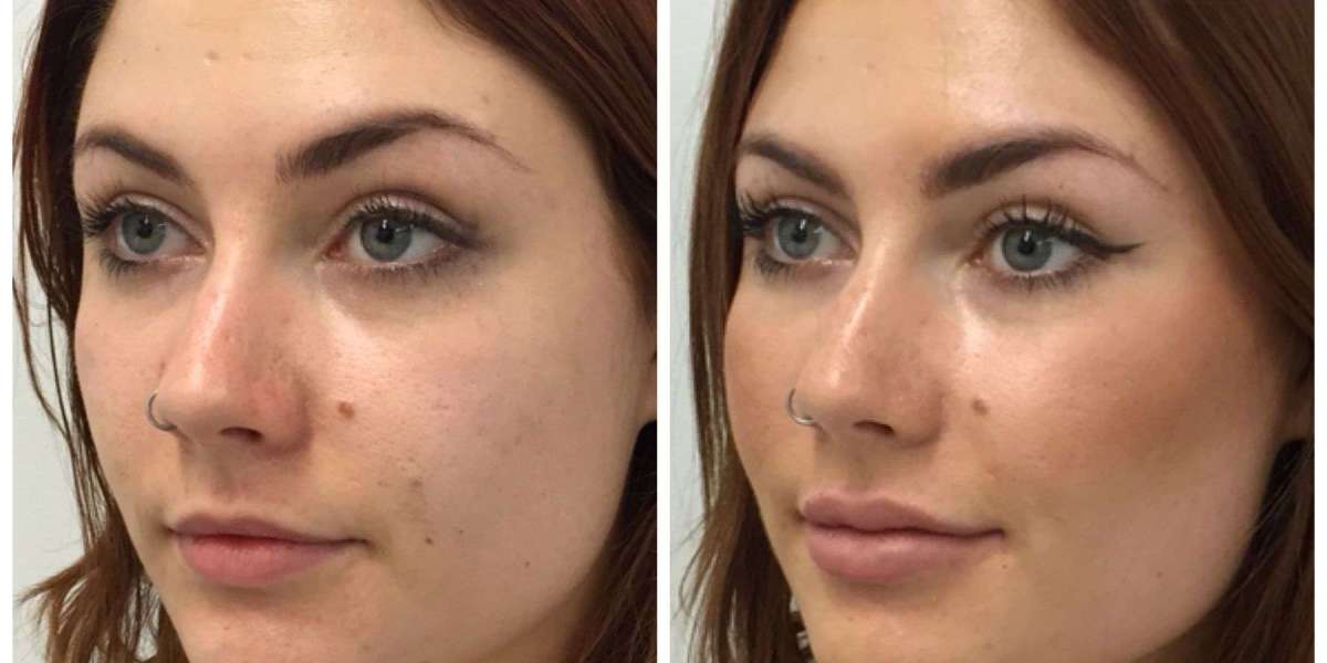 Why Patients Choose Cheek Augmentation in Riyadh for Mid-Face Volume