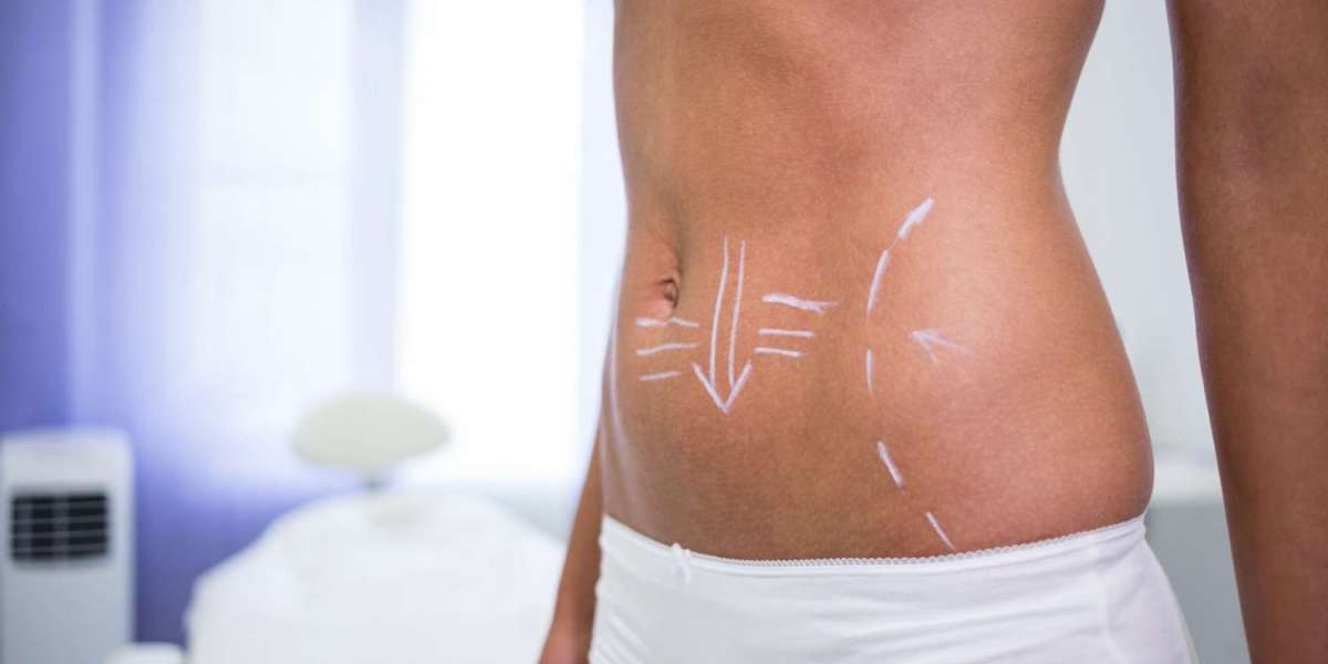 What to Expect Before, During, and After a Tummy Tuck in Dubai