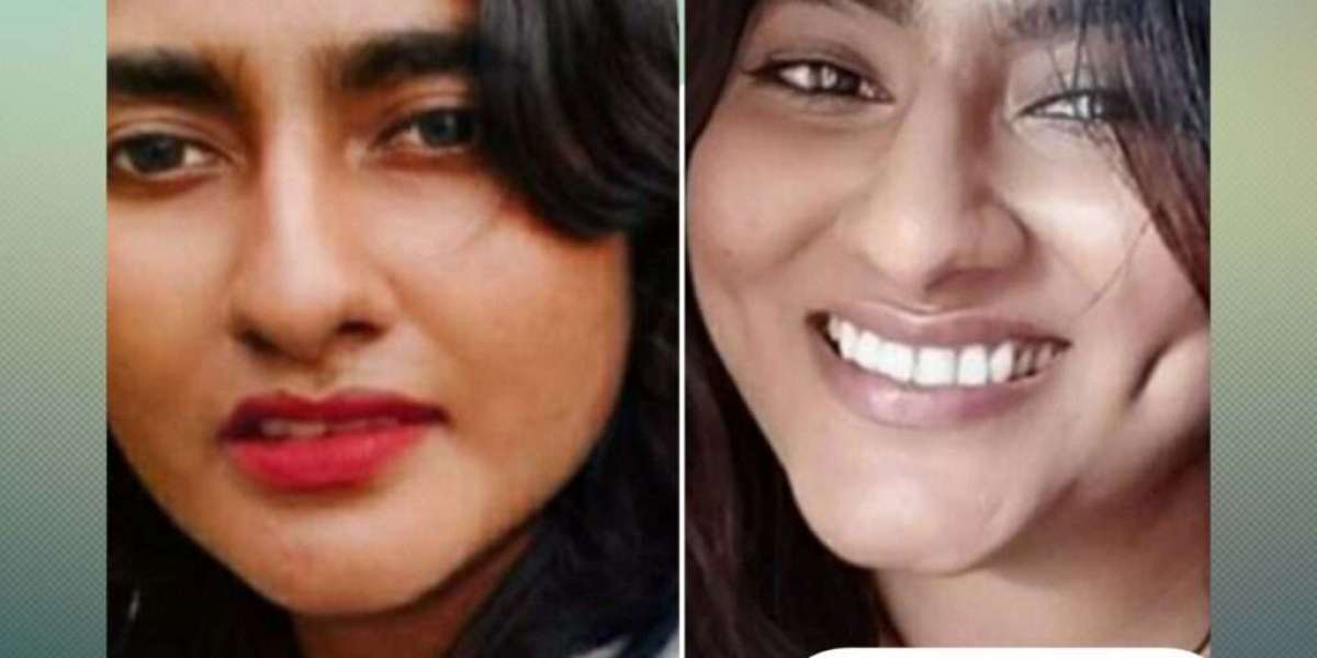 The Refinement of Facial Aesthetics: Dimple Creation in Jeddah