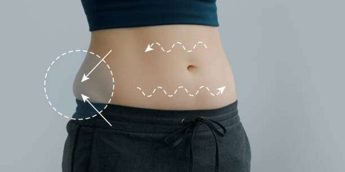 Who Is an Ideal Candidate for a Liposuction Procedure?