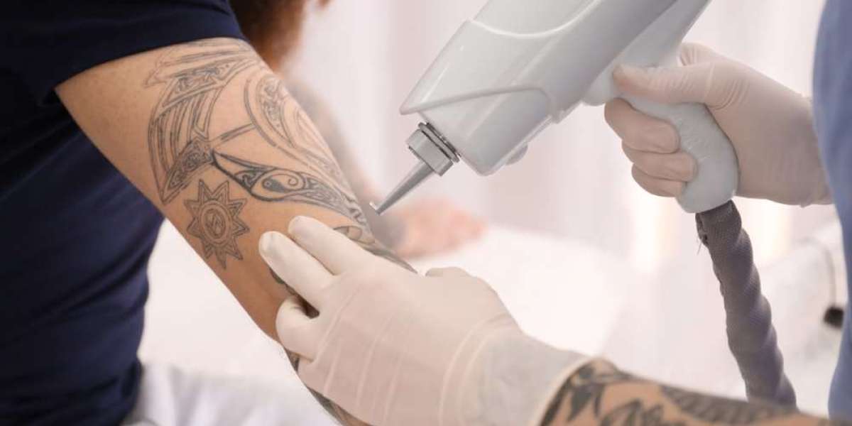 Tattoo Removal in Riyadh: Frequently Asked Questions
