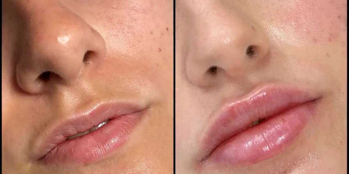 Best Plastic Surgeons in Dubai for Fillers Treatment Success