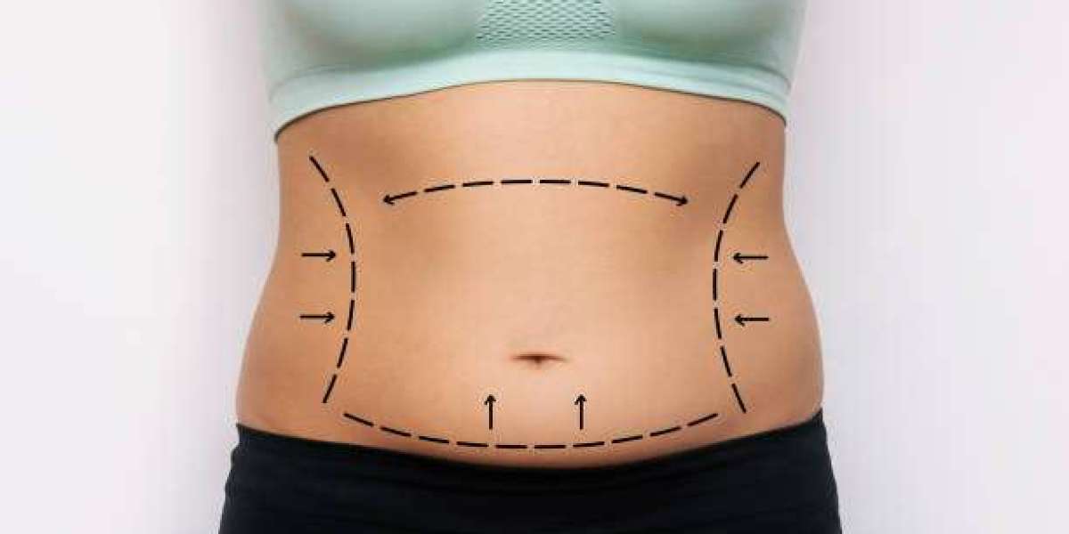Everything You Need to Know About Lipo Abdominoplasty in Riyadh