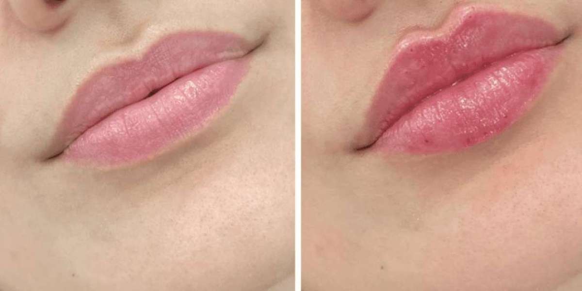 FDA-Approved Benefits of Juvederm in Dubai