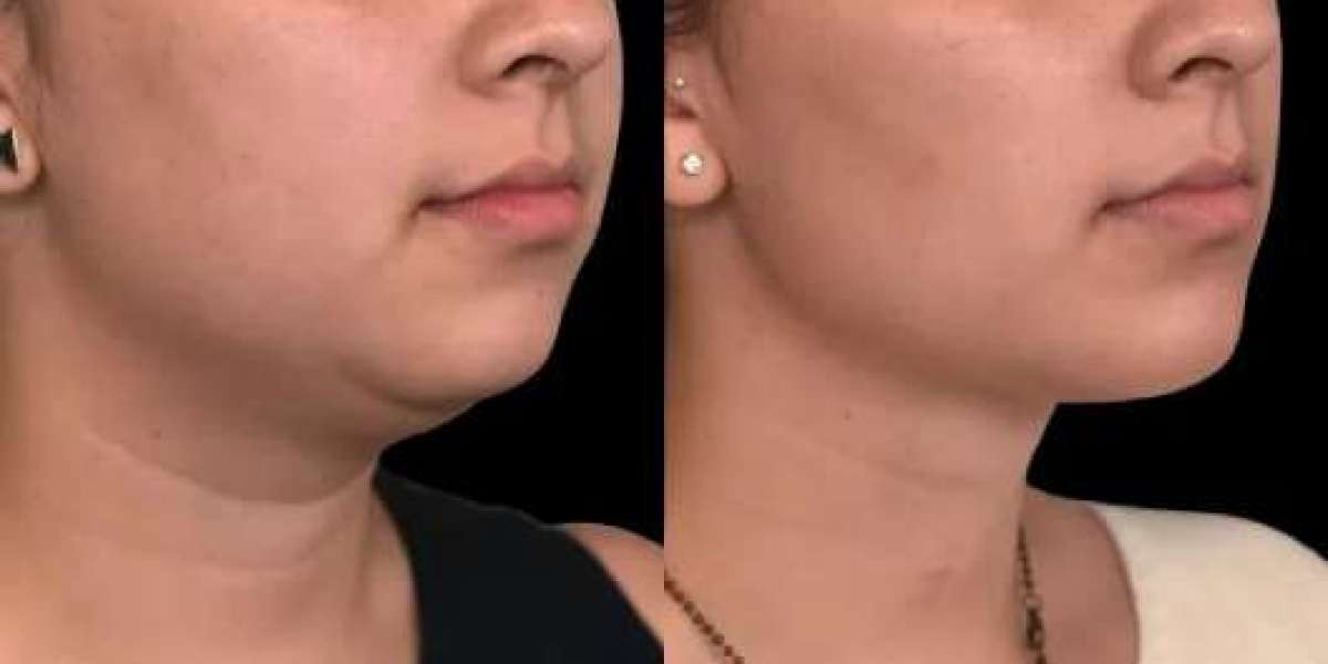 Best Double chin removal Surgeons in dubai Jawline Goals