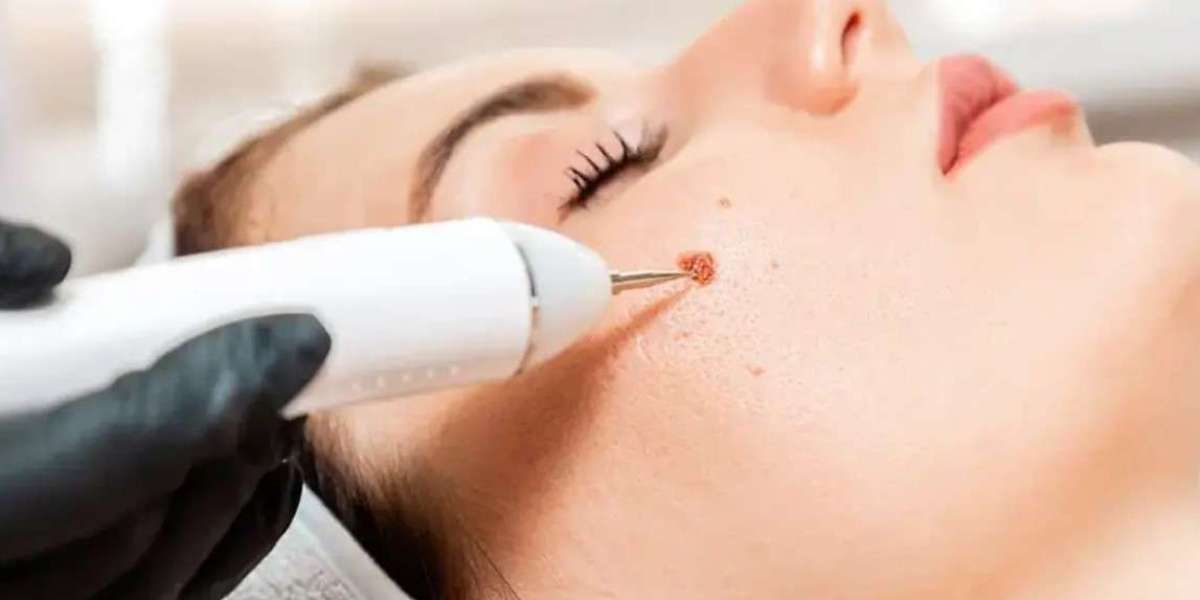 How to Identify a Benign Mole Before Removal