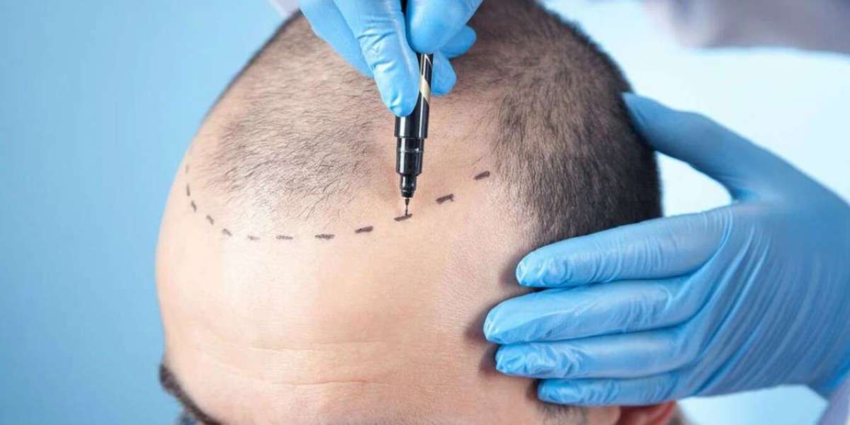 How to Care for Your Scalp After a Hair Transplant in Riyadh