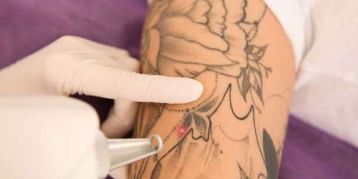 Tattoo Removal in Jeddah: The Role of Skin Elasticity and Aging